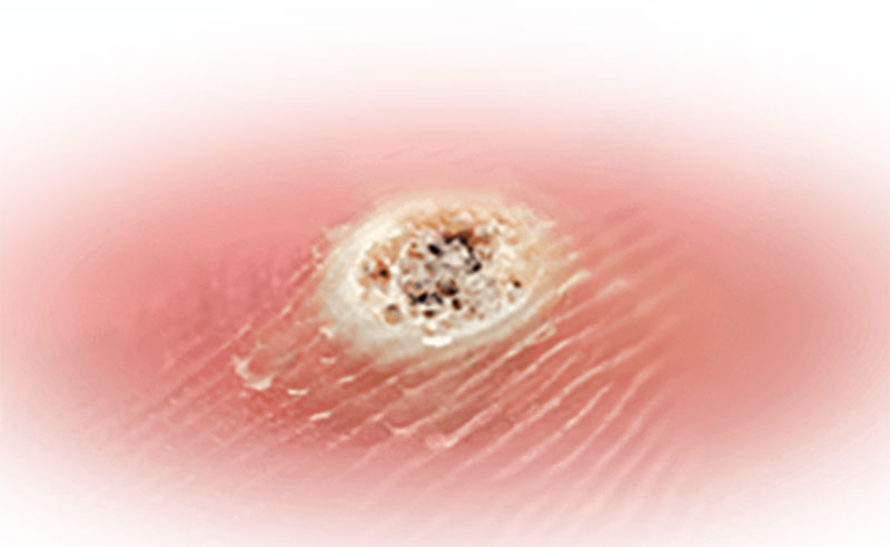 wart